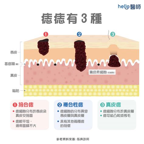 痣長毛|痣變大、痣多或長毛會變皮膚癌？認識痣的形成與原因